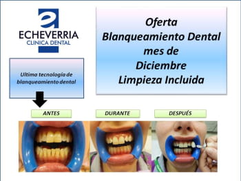 El Sistema de Blanqueamiento Nº1 Mundial