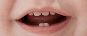 ¿Son importantes los dientes de leche?
