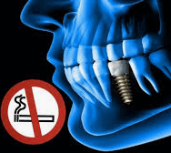 ¿Cómo influye el tabaco en los implantes dentales?